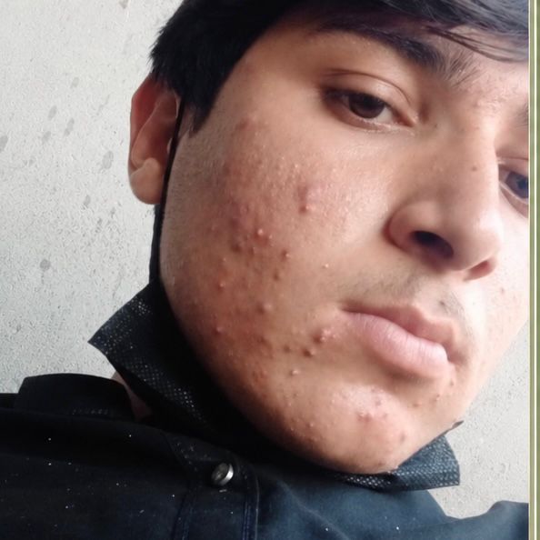 Before Acne Scar Treatment