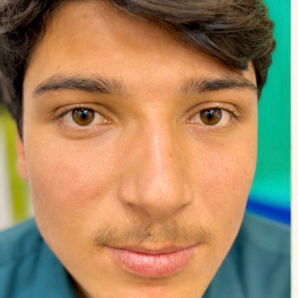 After Acne Scar Treatment