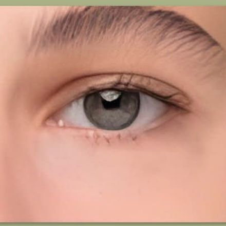 After Under-Eye Filler treatment