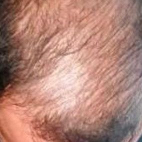 Before Hair Fall Treatment