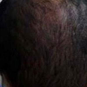 After Hair Fall Treatment